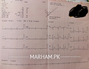 Angiogram Needed?