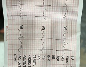 Fast Heart Rate