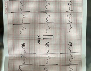 Fast Heart Rate