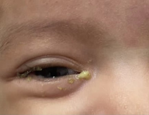 Eye Infection