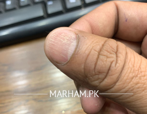 Nail Problem