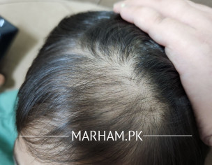 Bald Patch