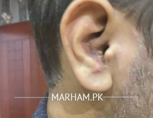 Pus Filled Pimples