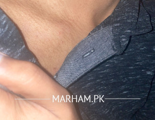 Pus Filled Pimples