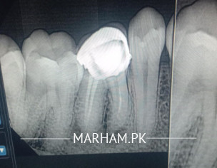 Teeth Infection