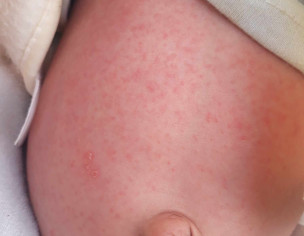 Skin Issue