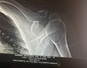 Left Clavicle Bone