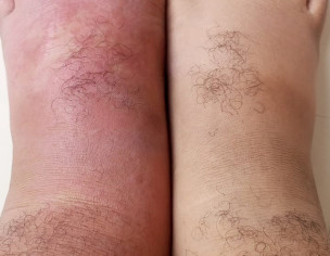 Swollen Leg