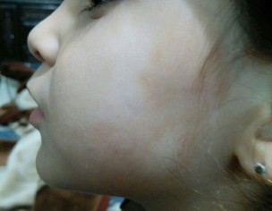 White Spots