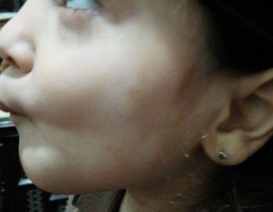 White Spots