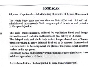 Cellulitis