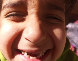 Teeth Decay