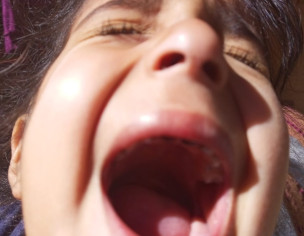 Teeth Decay