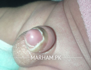 Circumcise