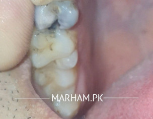 Teeth Damage
