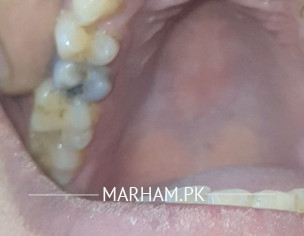 Teeth Damage