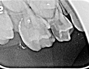 Deep Cavity 