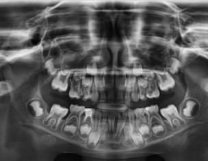Deep Cavity 