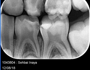 Deep Cavity 