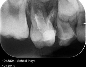Deep Cavity 