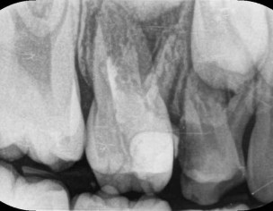 Deep Cavity 