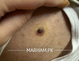 Skin Mole On Back