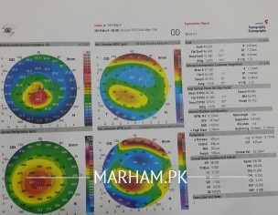 Keratoconus