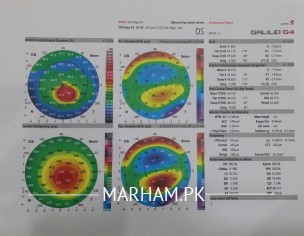 Keratoconus