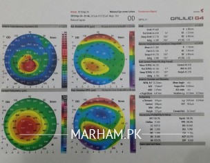 Keratoconus