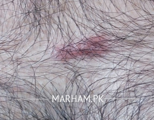 Skin Problem