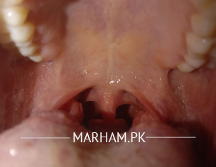 Throat Problem