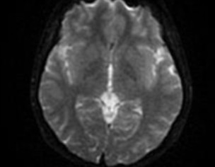 Neurological