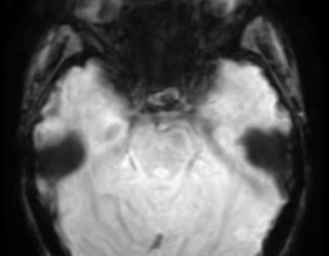 Neurological