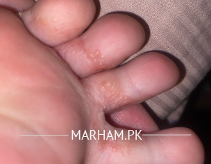 Bumps On Foot