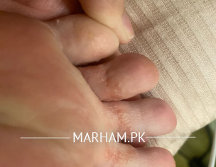Bumps On Foot
