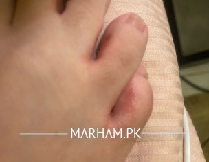 Bumps On Foot