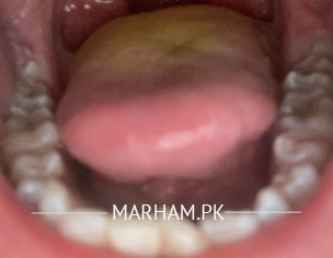 Big Tonsils 