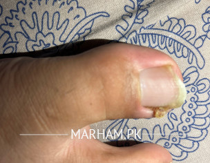 Ingrowing Toe Nail