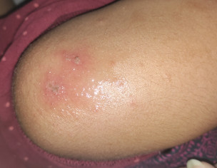 Having Allergy