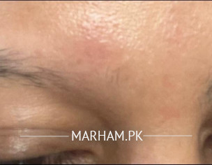 Eyebrow Loss