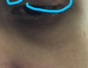 Ophthalmic 