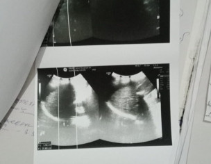 Liver Problem