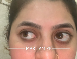 Eye Related Problem 