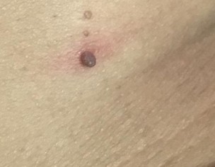 Skin Problem