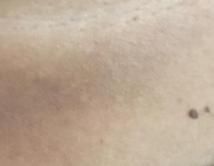Skin Problem
