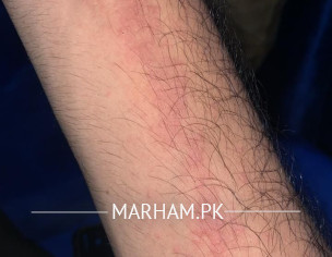 Itching