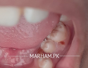 Dental Problem