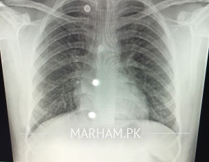 Cough And Mocus