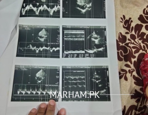 Heart Issue