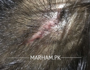 Head Wound